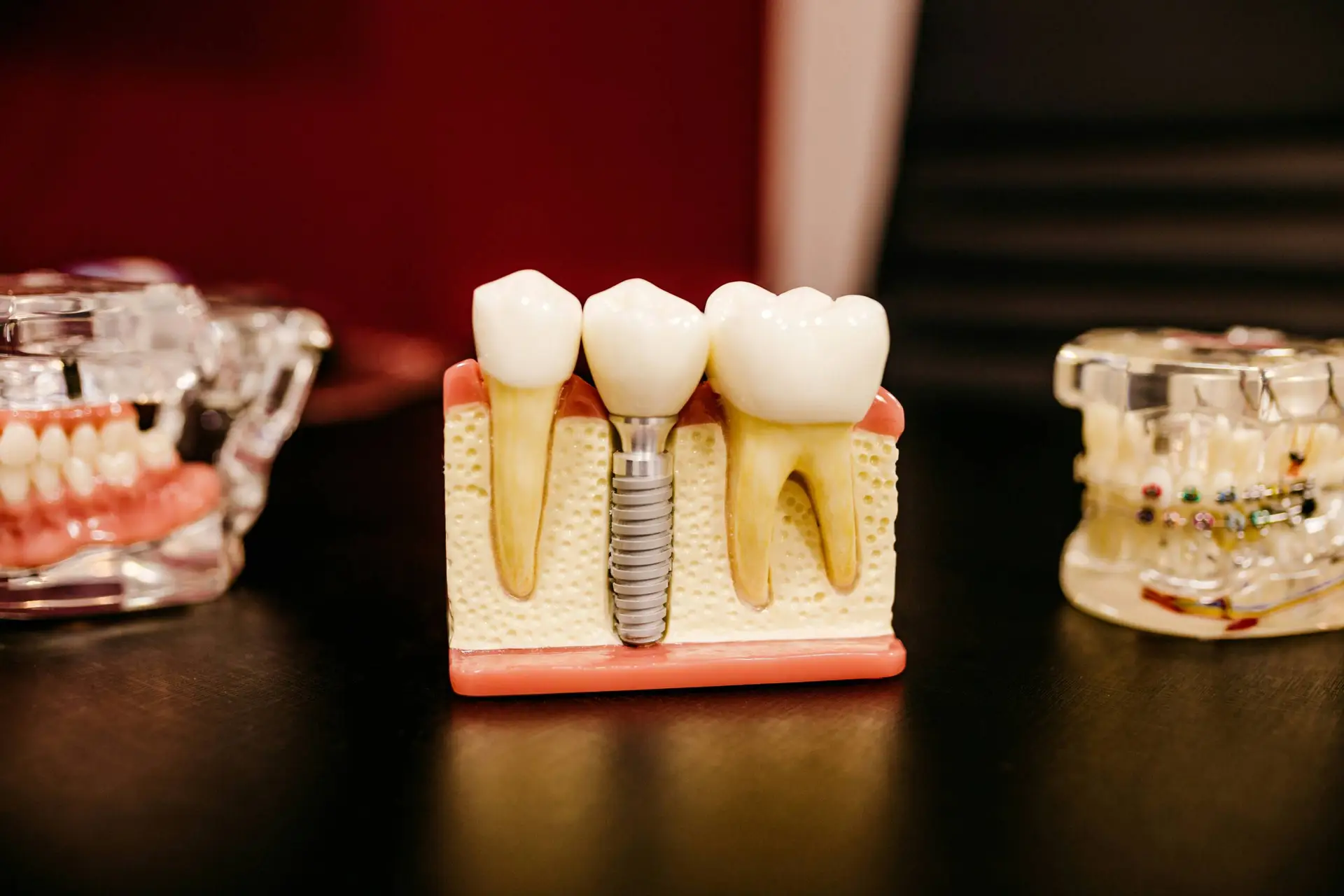 Dental Implants: Your Guide to a Confident and Sparking Smile