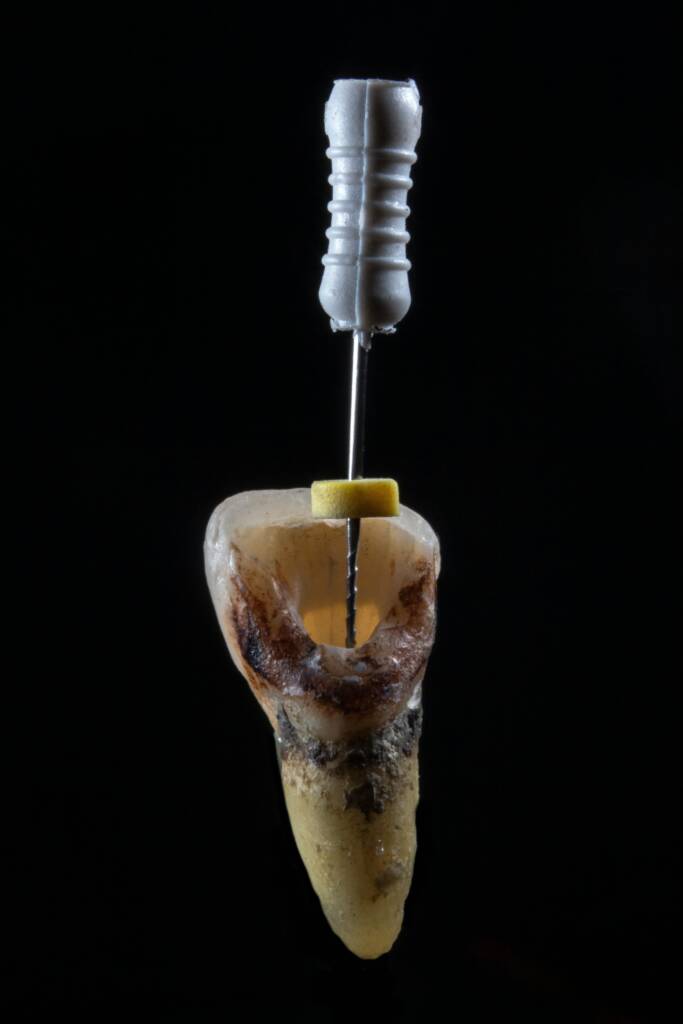 Tooth implant