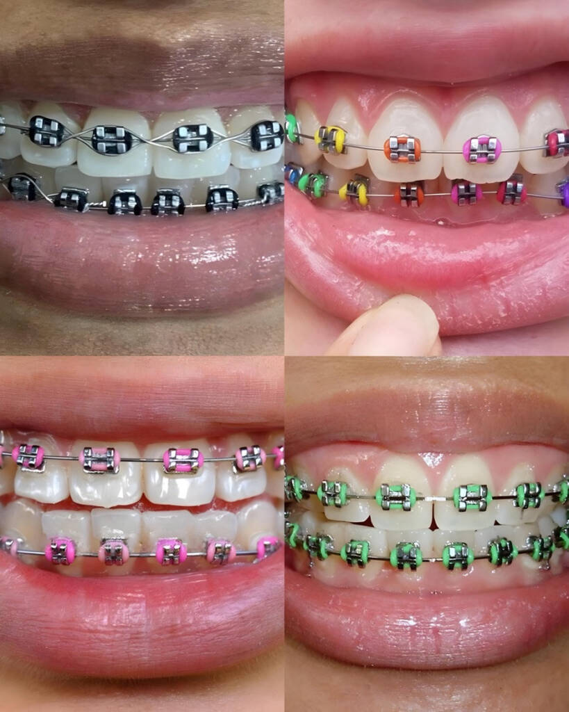 Fashion Braces