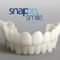 Snap On Veneers in Lagos